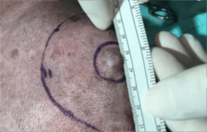 A vet wearing gloves measure the size of a cancerous lump on a veterinary patient.